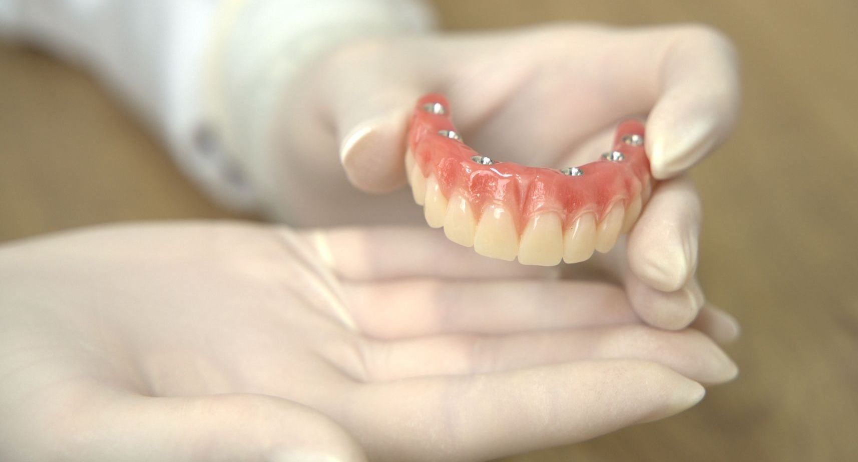 Prótese protocolo fixa sobre implantes dentários